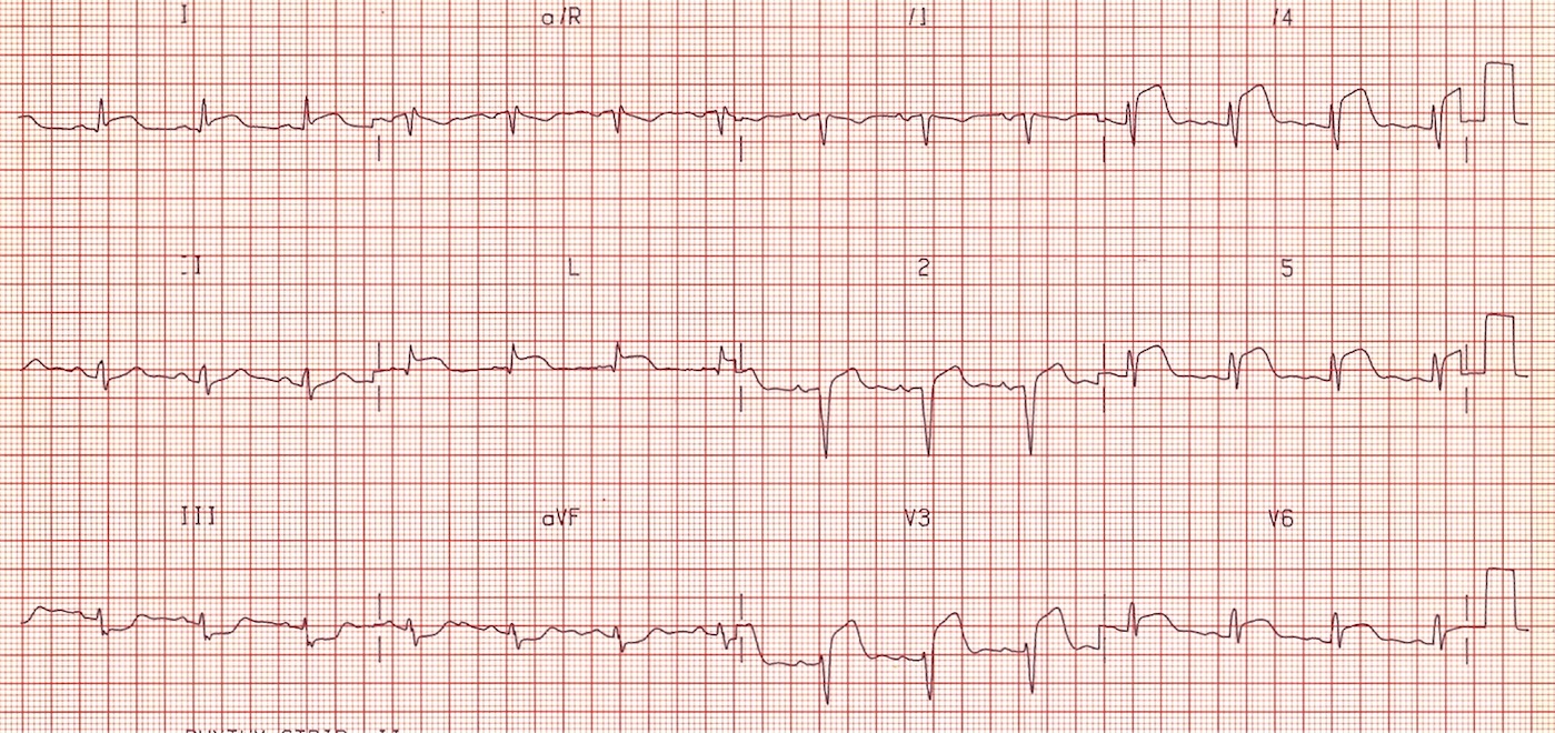 differentiating-normal-early-st-repolarization-versus-left-anterior