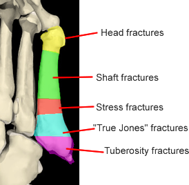 PEM Blog - Fracture Fridays: Dancing queen