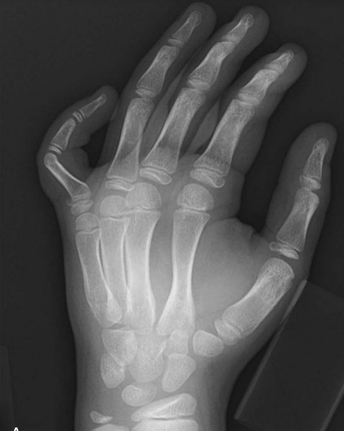 PEM Blog - Fracture Fridays: Can’t put a finger on it